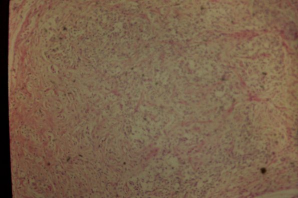 Cutaneous Lymphodonoma (9)