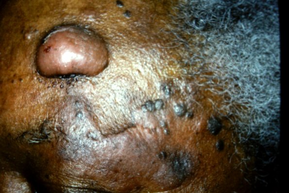 Cutaneous T Cell Lymphoma