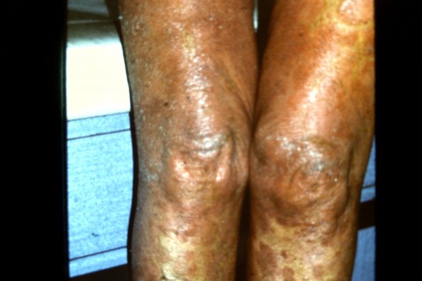 Epidermotropic Lymphoma