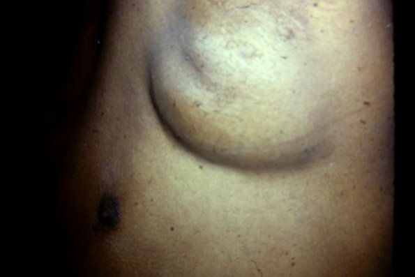 Lymphoma (18)