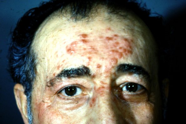 Lymphomatoid Papulosis (11)