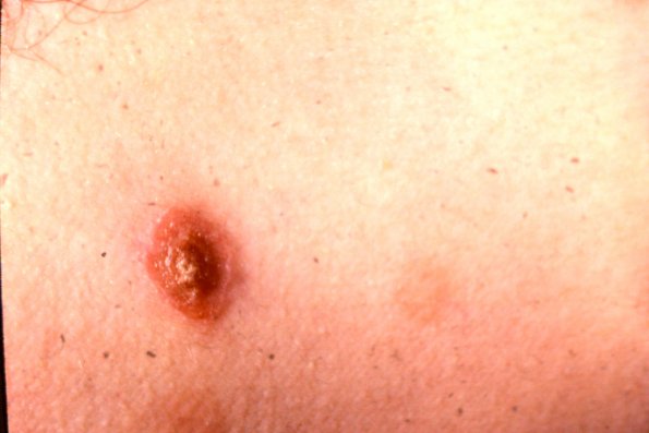 Lymphomatoid Papulosis (12)