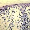 Lymphomatoid Papulosis (15)