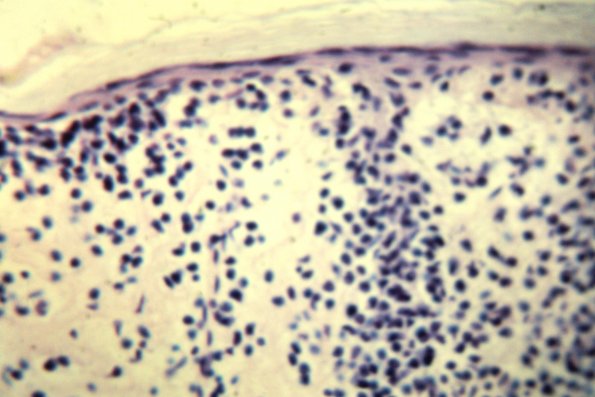 Lymphomatoid Papulosis (15)