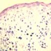 Lymphomatoid Papulosis (21)
