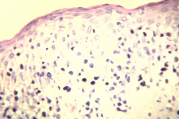 Lymphomatoid Papulosis (21)