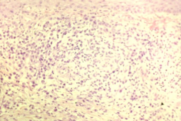 Lymphomatoid Papulosis (25)