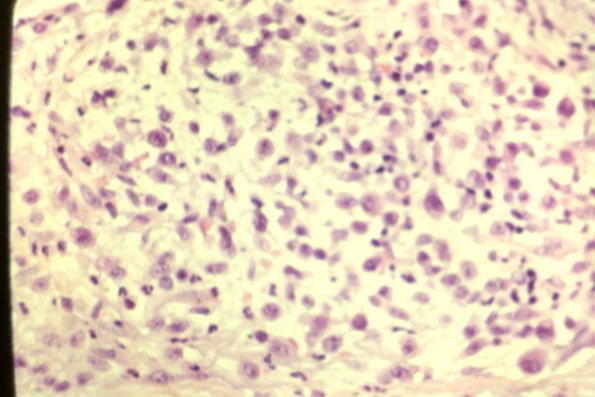 Lymphomatoid Papulosis (26)