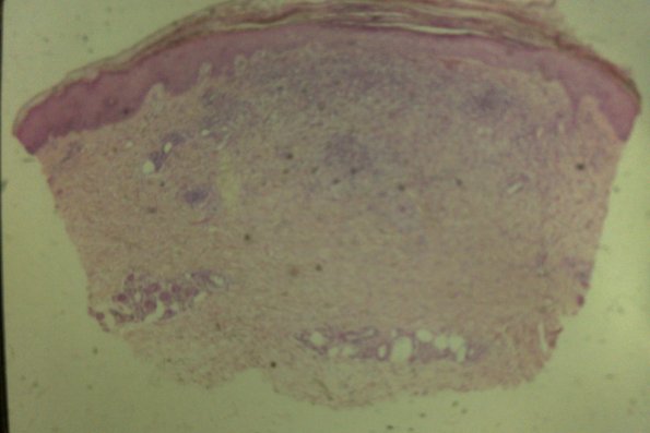 Lymphomatoid Papulosis (29)