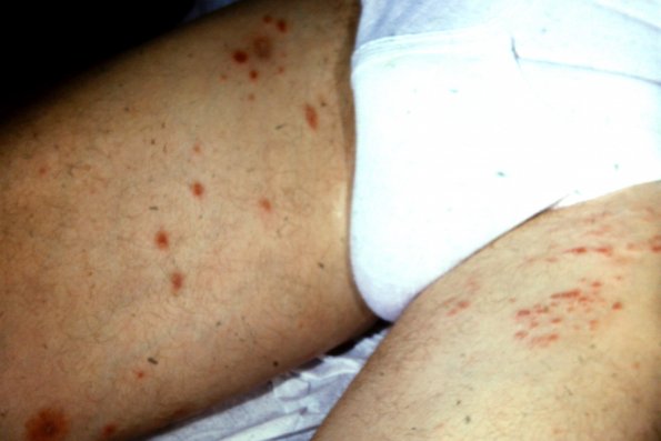 Lymphomatoid Papulosis (6)