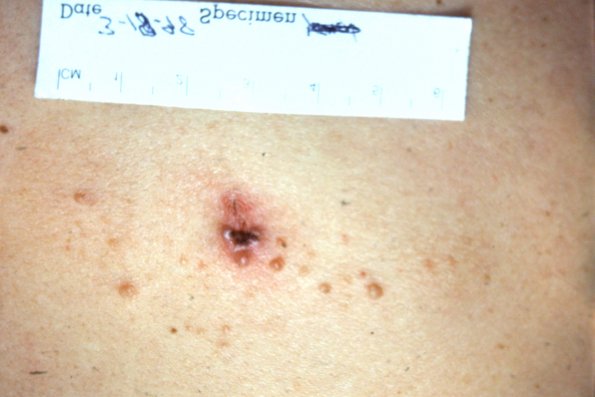 Lympnangioma