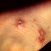 Malakoplakia CMV Infection (2)