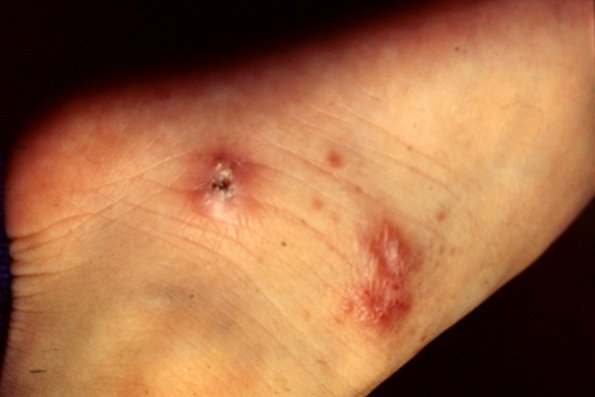 Malakoplakia CMV Infection (2)