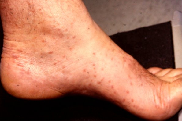 Urticaria Pigmentosa Mastocytosis (11)