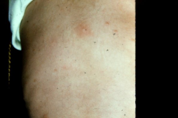 Urticaria Pigmentosa Mastocytosis (2)