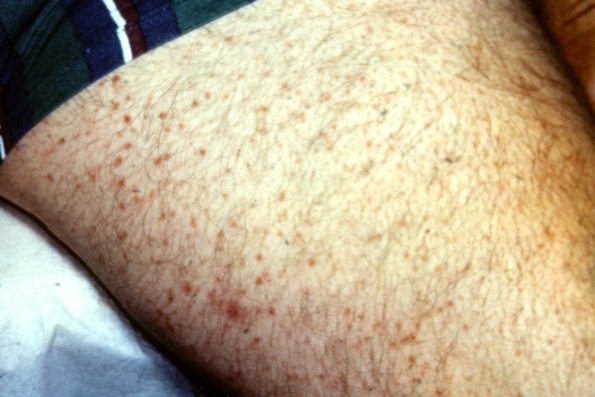 Urticaria Pigmentosa Mastocytosis (3)