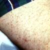 Urticaria Pigmentosa Mastocytosis (4)