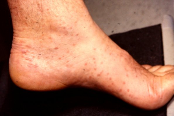 Urticaria Pigmentosa Mastocytosis (7)