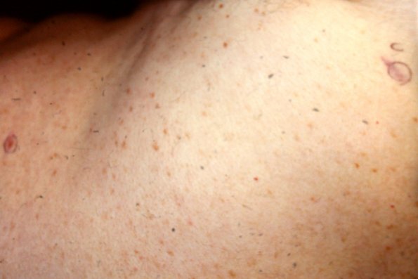 Urticaria Pigmentosa Mastocytosis (8)