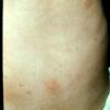 Urticaria Pigmentosa Mastocytosis