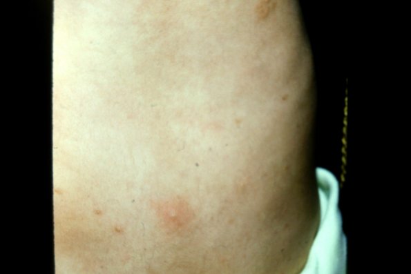 Urticaria Pigmentosa Mastocytosis