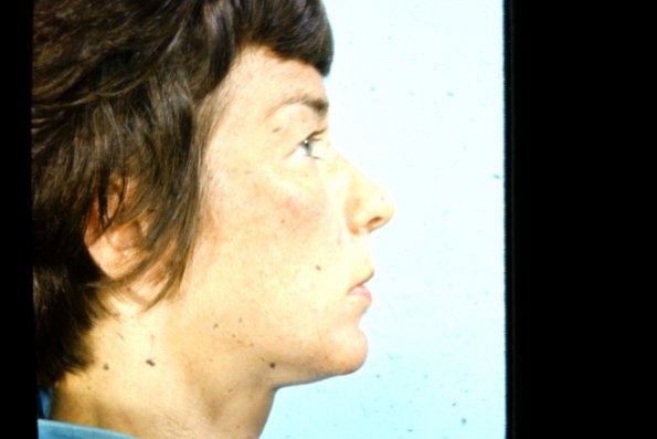 Melasma