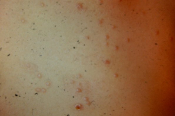 Molluscum Contagiosum (4)