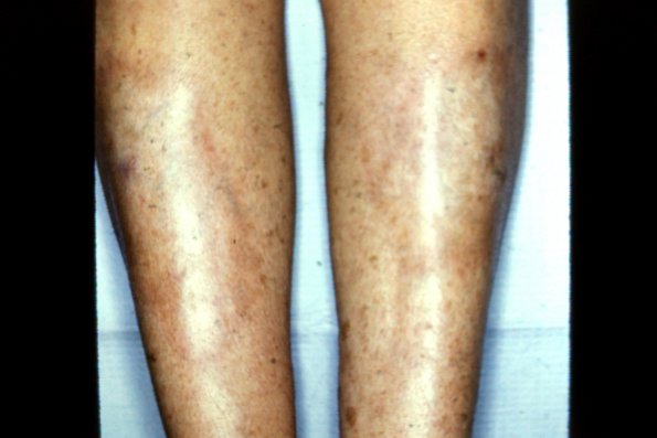 Morphea (6)