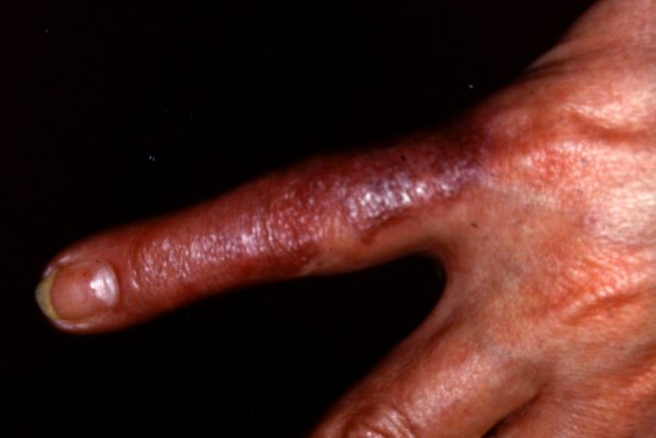 Mycetoma Nocardia