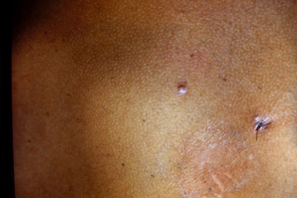 Mycosis Fungoides (13)