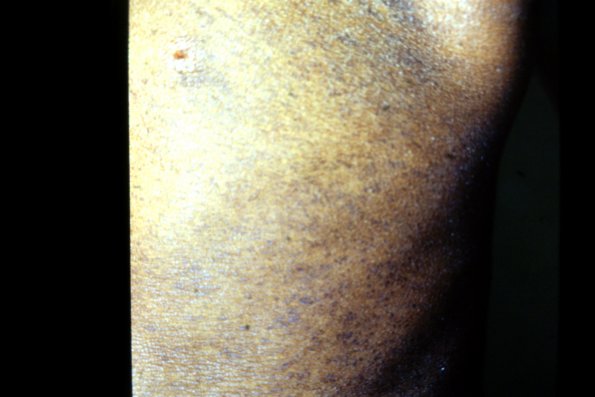 Mycosis Fungoides (15)