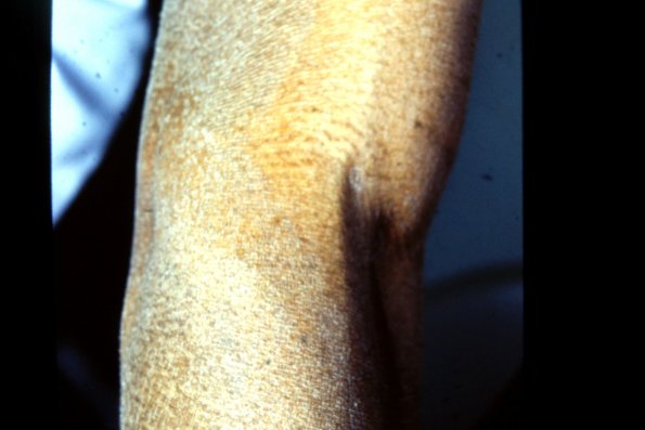 Mycosis Fungoides (20)