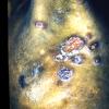 Mycosis Fungoides (22)