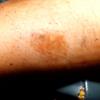 Mycosis Fungoides (26)