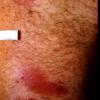 Mycosis Fungoides (27)