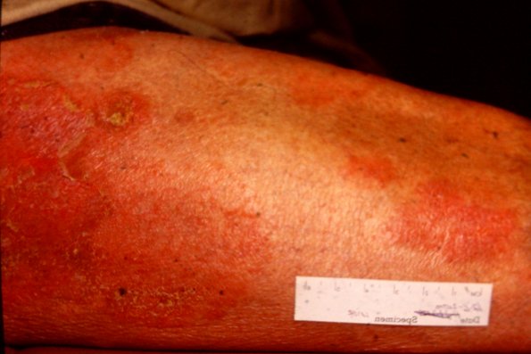 Mycosis Fungoides (28)