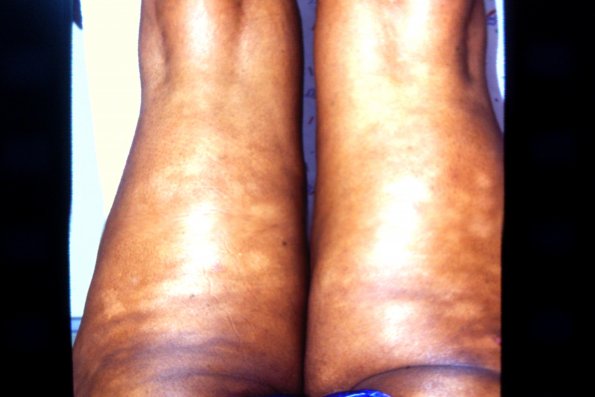Mycosis Fungoides (3)