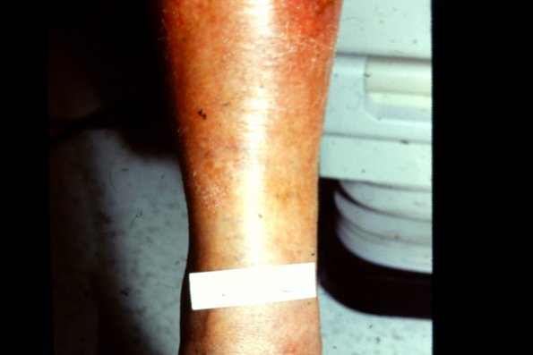 Mycosis Fungoides (32)
