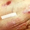 Mycosis Fungoides (40)