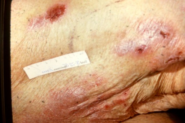 Mycosis Fungoides (40)