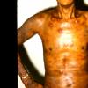 Mycosis Fungoides (41)