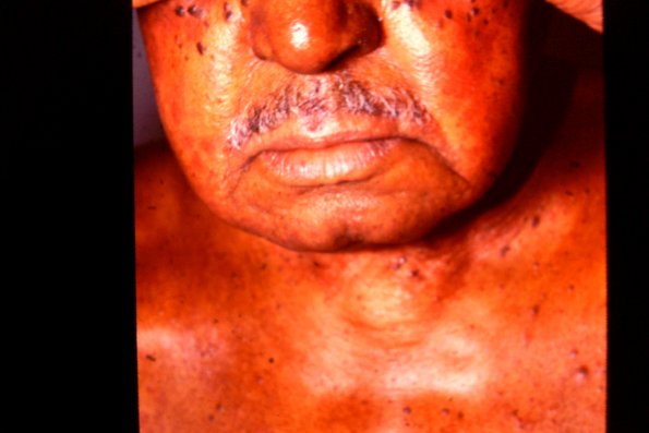 Mycosis Fungoides (43)