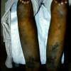 Mycosis Fungoides (44)