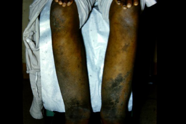 Mycosis Fungoides (44)