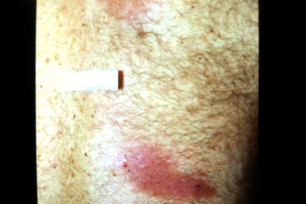Mycosis Fungoides (5)
