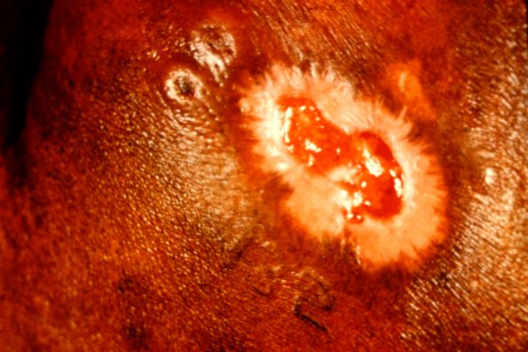 Mycosis Fungoides (51)