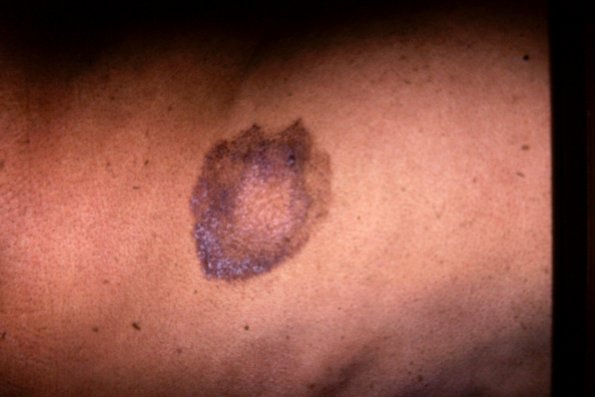 Mycosis Fungoides (54)