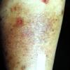 Mycosis Fungoides (9)