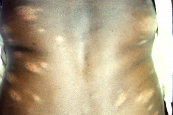 Mycosis Fungoides