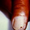 Keratoacanthoma Of Nailbed